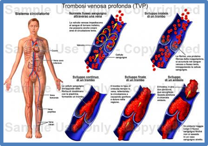 Le vene su varicosity sono state gonfiate