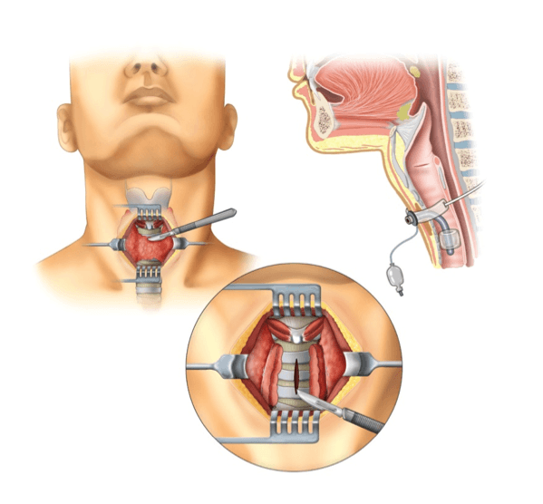 Figura 3. Incisione chirurgica della trachea