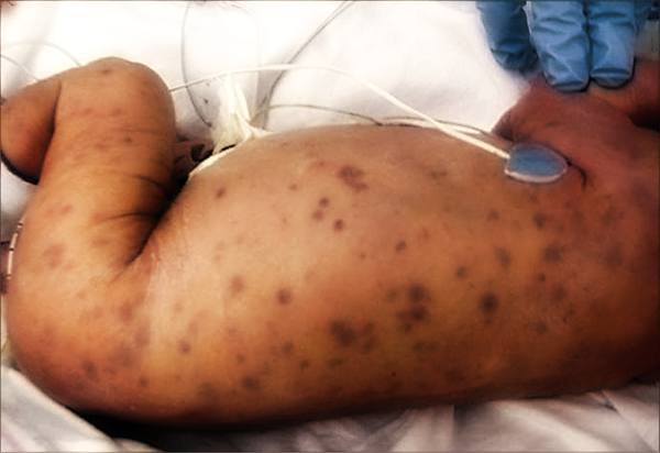 Citomegalovirus in gravidanza: come si contrae, sintomi e cure