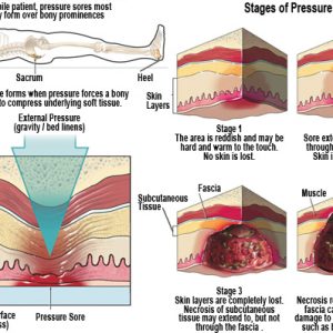 Pressure-Ulcers-3