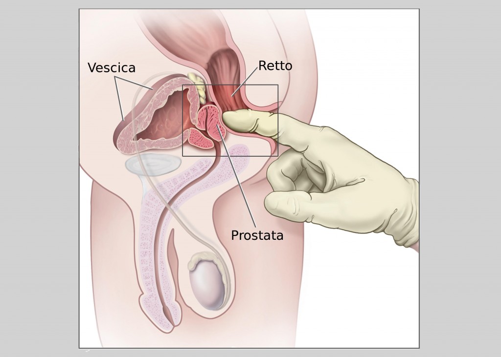 valutazioni infermieristiche per il cancro alla prostata