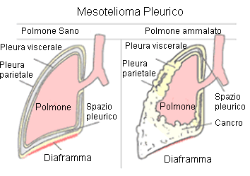 Mesotelioma pleurico