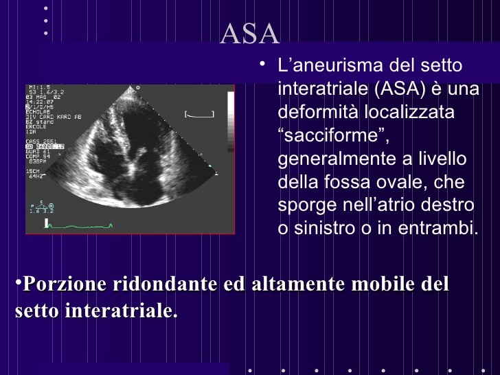 Rapporto tra Ictus e Aneurisma Setto Interatriale