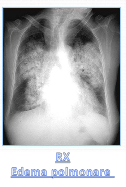 Cause non cardiogene di edema polmonare