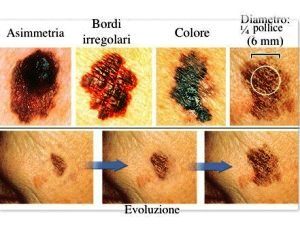 Attenti al sole! I consigli per l'esposizione e la diagnosi precoce del melanoma 1