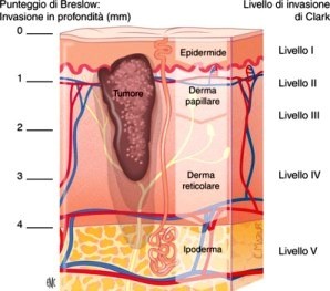 Attenti al sole! I consigli per l'esposizione e la diagnosi precoce del melanoma