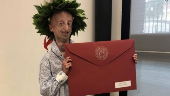 Sammy Basso, volto simbolo della lotta alla Progeria, si laurea con il massimo dei voti