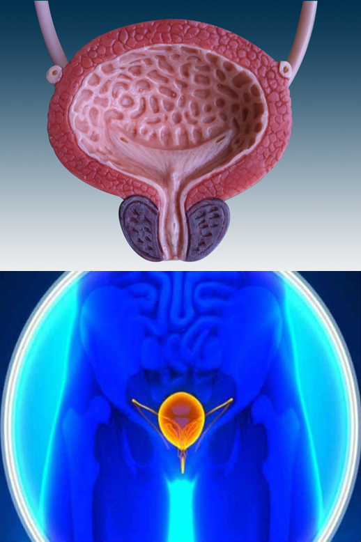 Vescica neurologica 1