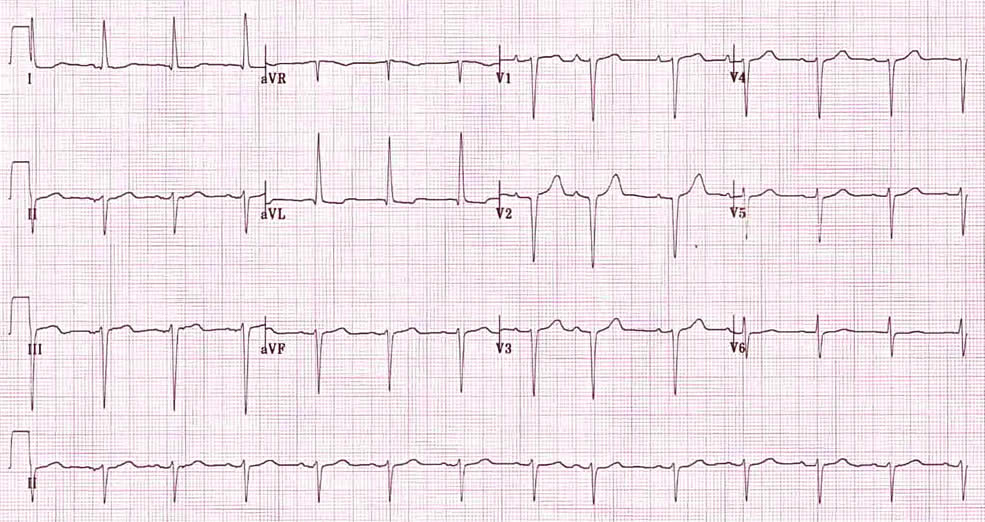 Emiblocco Anteriore Sinistro ed Emiblocco Posteriore Sinistro 1