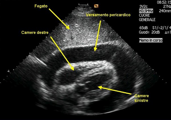 Pericardiocentesi in emergenza: rescue life 1