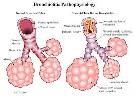 Bronchioliti, cause, sintomi, diagnosi e prevenzione 2