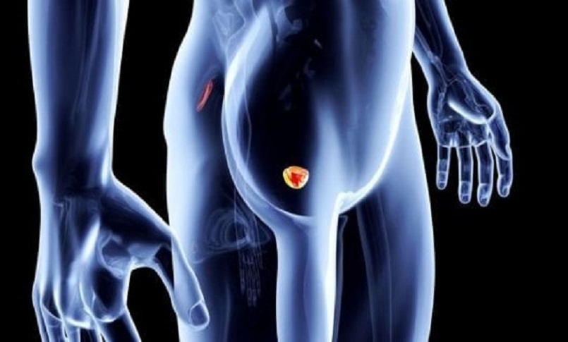 tumore alla prostata 3 3d