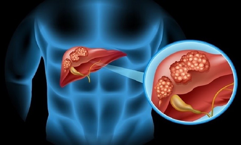 Colangiocarcinoma Gli Inganni Di Un Tumore Sempre Meno